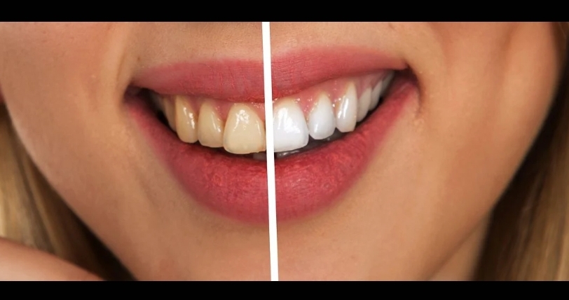 5  prirodnih načina za izbeljivanje zuba